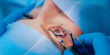 Óculos vão ser extintos? Médica esclarece verdades sobre cirurgia refrativa