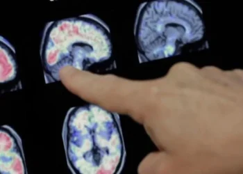 Alzheimer - Foto: (Imagem/Reprodução)