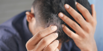 Entenda motivo do Minoxidil revolucionar tratamento contra queda de cabelo