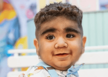 Bebês expostos a minoxidil podem sofrer com síndrome