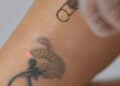 Tendência de apagar tatuagens ganha força entre brasileiros; entenda