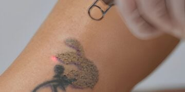 Tendência de apagar tatuagens ganha força entre brasileiros; entenda