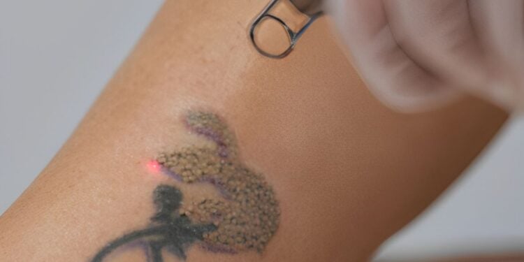 Tendência de apagar tatuagens ganha força entre brasileiros; entenda