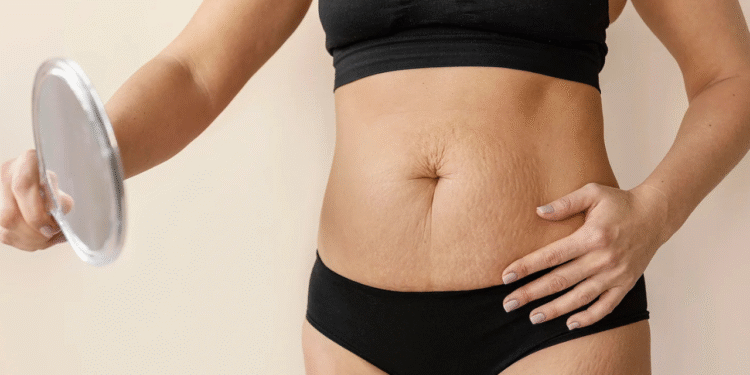 Causas da diástase abdominal são reveladas