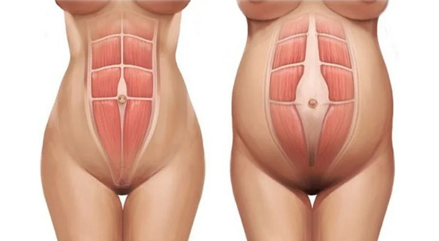 Causas da diástase abdominal são reveladas