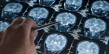 Essas doenças causam deterioração cerebral rápida e são sempre fatais