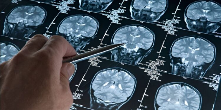 Essas doenças causam deterioração cerebral rápida e são sempre fatais