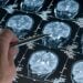 Essas doenças causam deterioração cerebral rápida e são sempre fatais