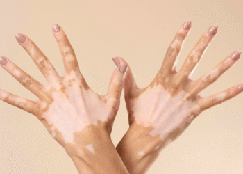 Quais são as causas do vitiligo? Condição atinge até 2% da população