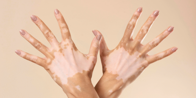 Quais são as causas do vitiligo? Condição atinge até 2% da população