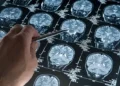 Alzheimer - Reprodução/iStock