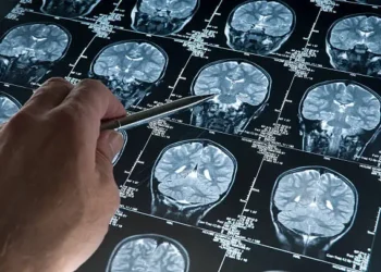 Alzheimer - Reprodução/iStock