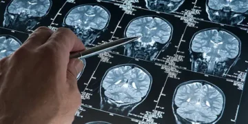 Alzheimer - Reprodução/iStock