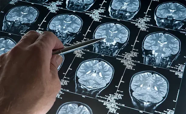 Alzheimer - Reprodução/iStock