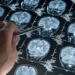 Alzheimer - Reprodução/iStock