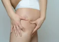 Flacidez nas coxas - Reprodução/iStock