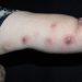 esporotricose