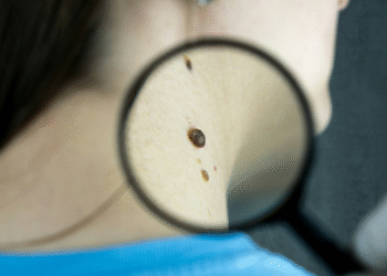 Casos de manchas na pele que precisam de atenção