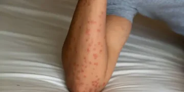 Mosquitos - Reprodução/iStock