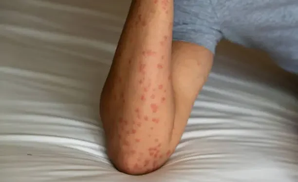 Mosquitos - Reprodução/iStock