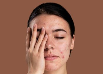 Cientistas trabalham em vacinas que prometem eliminar acne