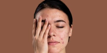 Cientistas trabalham em vacinas que prometem eliminar acne