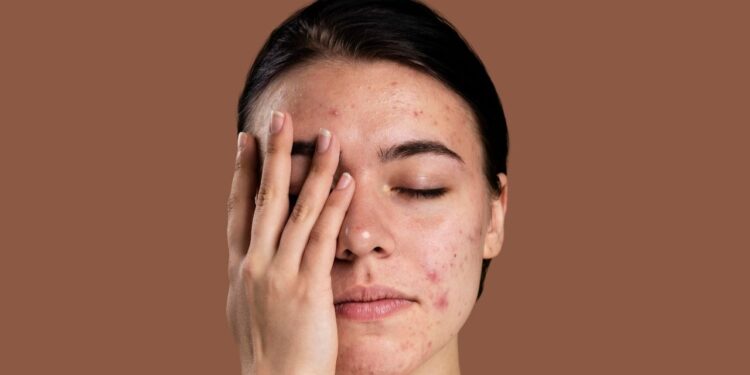 Cientistas trabalham em vacinas que prometem eliminar acne