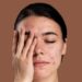 Cientistas trabalham em vacinas que prometem eliminar acne