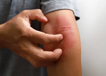 Dermatite atópica - Reprodução/iStock