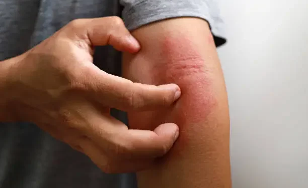 Dermatite atópica - Reprodução/iStock
