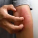 Dermatite atópica - Reprodução/iStock