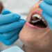 Obturações no dente
