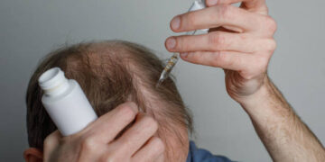 Minoxidil - Reprodução/iStock