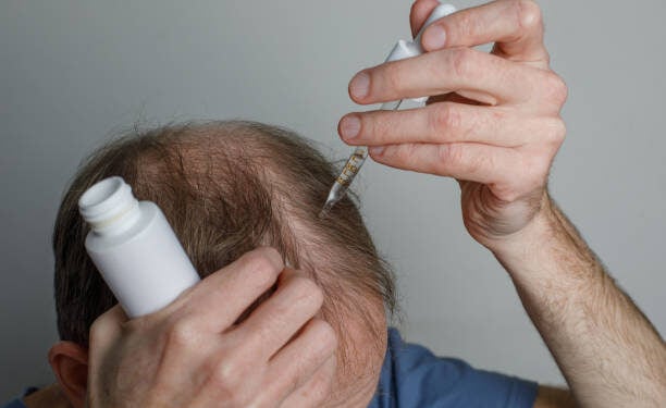 Minoxidil - Reprodução/iStock