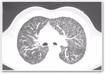 Foto: ASM Case Reports