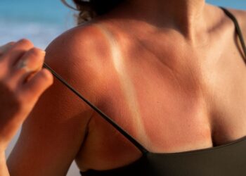 Pegou sol demais? Veja o que realmente ajuda a recuperar a pele queimada