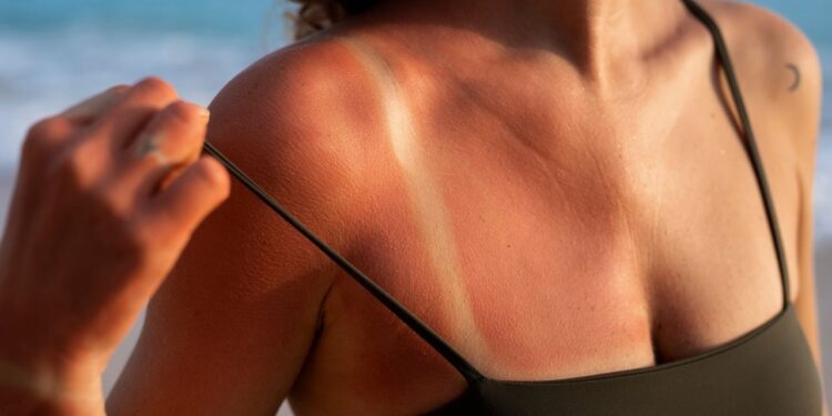 Pegou sol demais? Veja o que realmente ajuda a recuperar a pele queimada