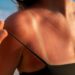 Pegou sol demais? Veja o que realmente ajuda a recuperar a pele queimada