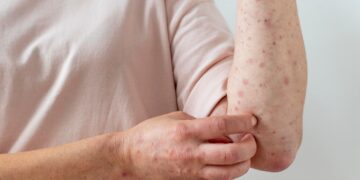 Cidade brasileira está preocupada com surto de casos de sarna humana