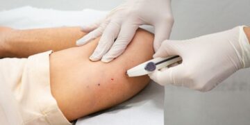 Implanon pelo SUS: saiba como garantir método contraceptivo mais eficaz