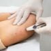 Implanon pelo SUS: saiba como garantir método contraceptivo mais eficaz