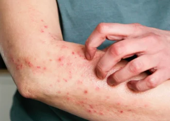 doença Mpox