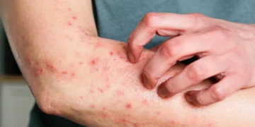doença Mpox