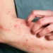 doença Mpox