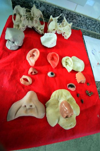 'Recomeço' da vida para dez pacientes 2 Próteses são produzidas em impressão em 3D