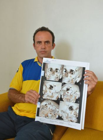 Assaltantes agem contra carteiros em JF e região 2 Walace Fonseca mostra radiografias da face fraturada durante assalto no Bairu (Marcelo Ribeiro/19-02-16)