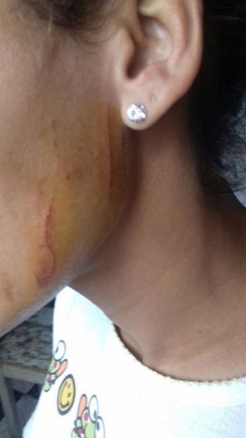 Servidores de saúde acuados após mais uma agressão 2 Servidora, de 31 anos, teve o cabelo puxado e o rosto arranhado diversas vezes
