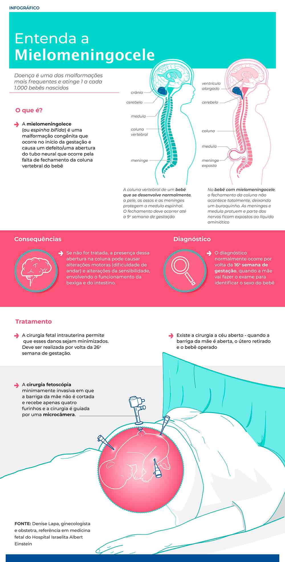 Mielomeningocele: cirurgia dentro do útero  possibilita que crianças consigam andar