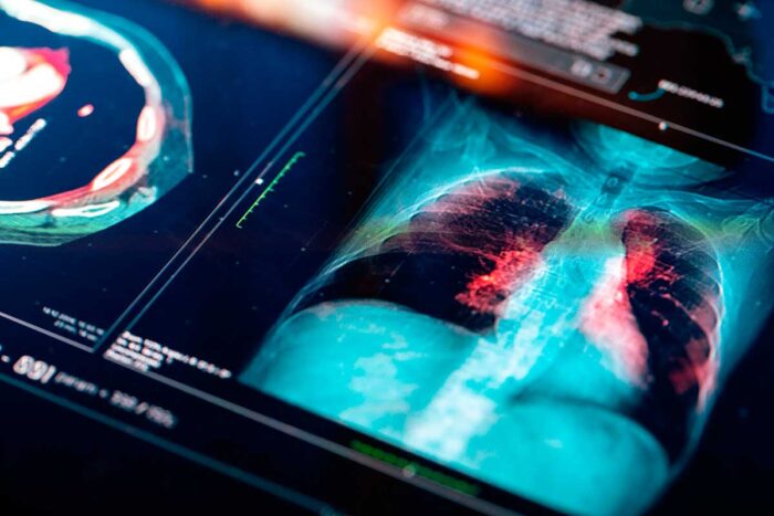 sequela pulmonar covid foto reproducao Instituto Somed