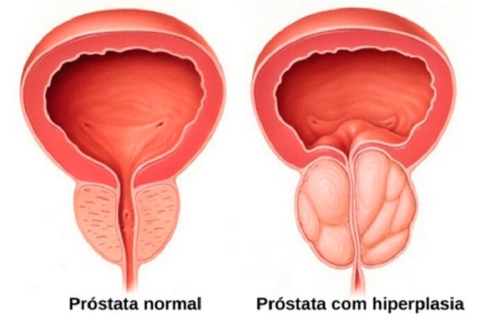 prostata aumentada reproducao daniel moser